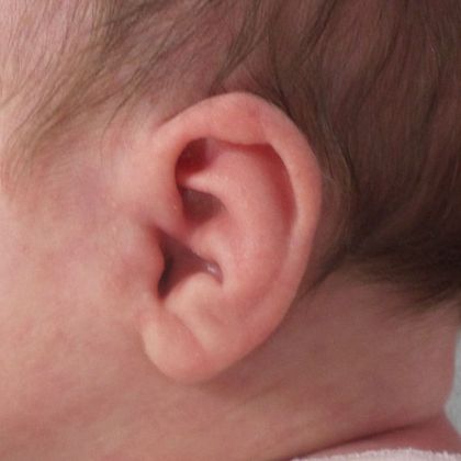 Ear Molding: Case 59 - Before