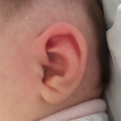 Ear Molding: Case 59 - After