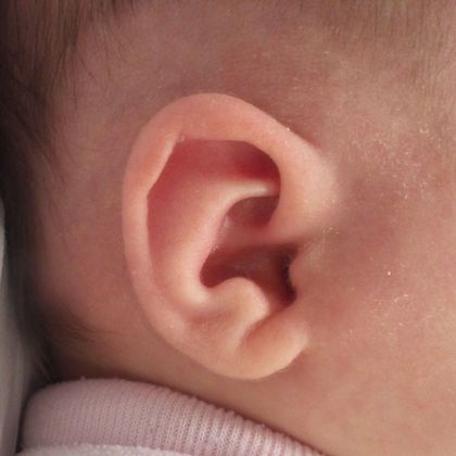 Ear Molding: Case 60 - After