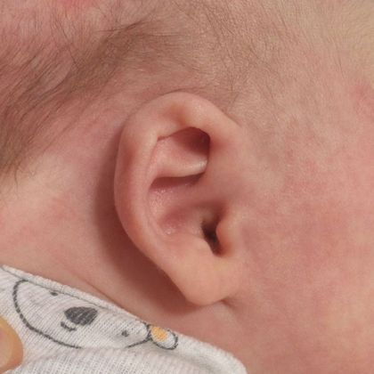 Ear Molding Case 61 - Before