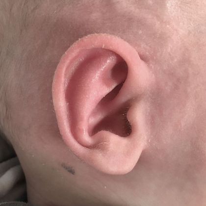 Ear Molding Case 63 - After