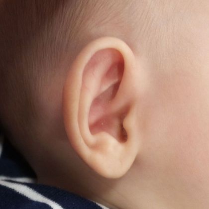 Ear Molding Case 63 - Before