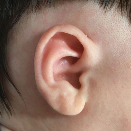 Ear Molding Case 64 - After