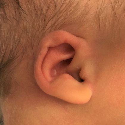 Ear Molding: Case 65 - Before
