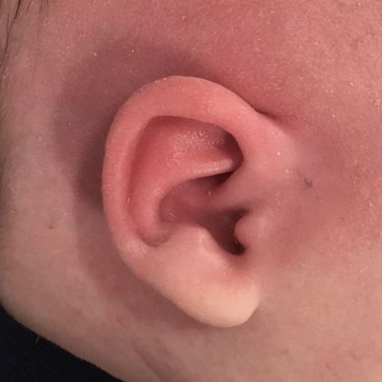 Ear Molding: Case 65 - After
