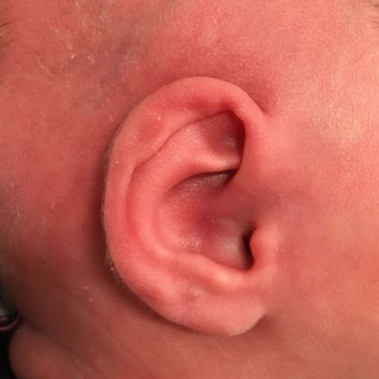 Ear Molding: Case 67 - Before
