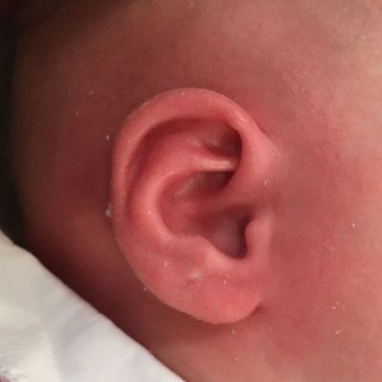 Ear Molding: Case 67 - After