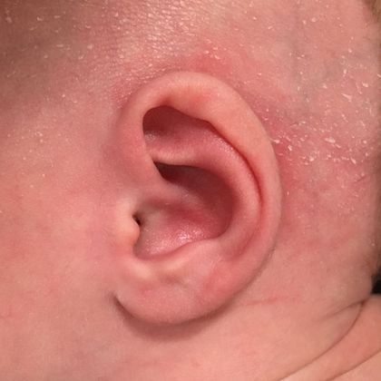 Ear Molding Case 68 - Before