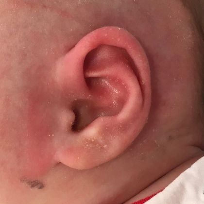 Ear Molding Case 68 - After