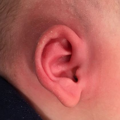 Ear Molding Case 70 - After