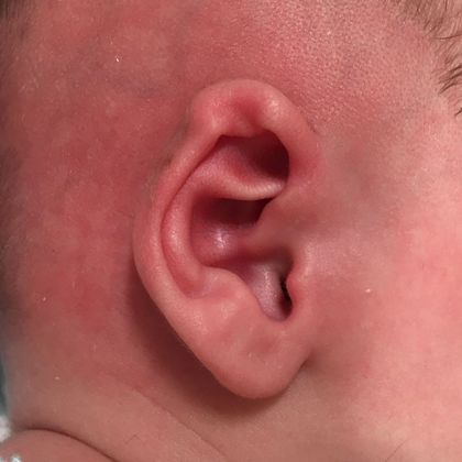 Ear Molding Case 71 - Before