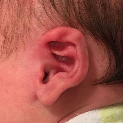 Ear Molding: Case 72 - Before