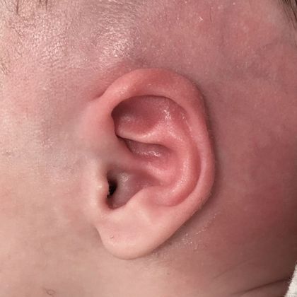 Ear Molding: Case 72 - After