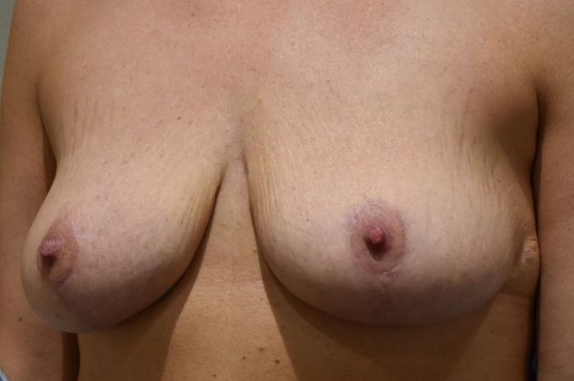 Breast Lift (Mastopexy): Case 87 - After