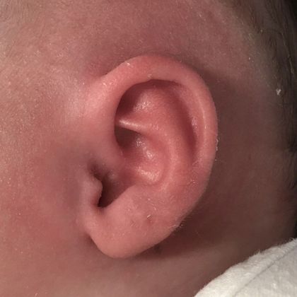 Ear Molding: Case 74 - After