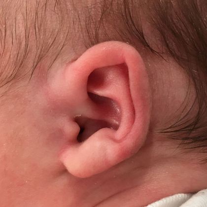 Ear Molding: Case 74 - Before
