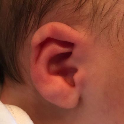 Ear Molding: Case 75 - Before