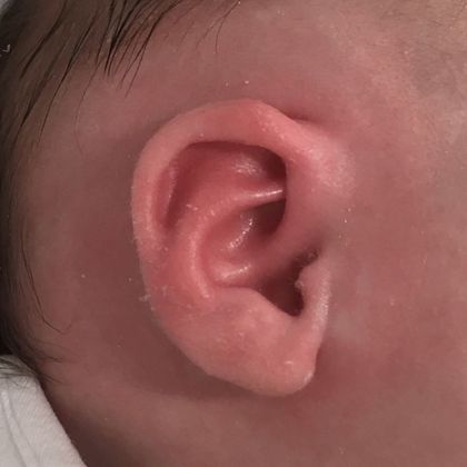 Ear Molding: Case 75 - After