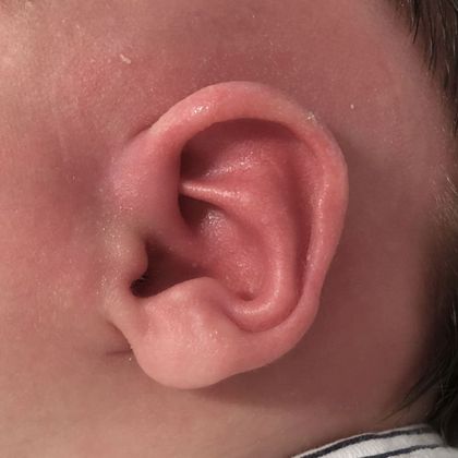 Ear Molding Case 76 - After