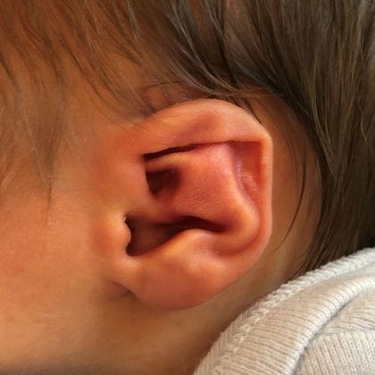 Ear Molding Case 76 - Before