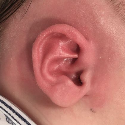 Ear Molding: Case 77 - After