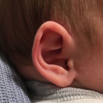 Ear Molding: Case 78 - Before