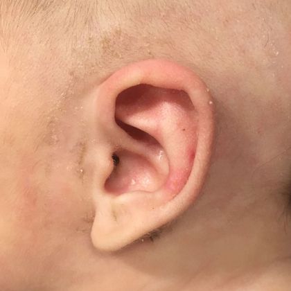 Ear Molding Case 79 - After