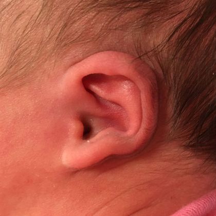 Ear Molding Case 80 - Before