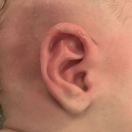 Ear Molding: Case 82 - After