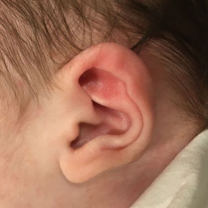 Ear Molding: Case 85 - Before