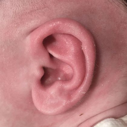 Ear Molding: Case 85 - After