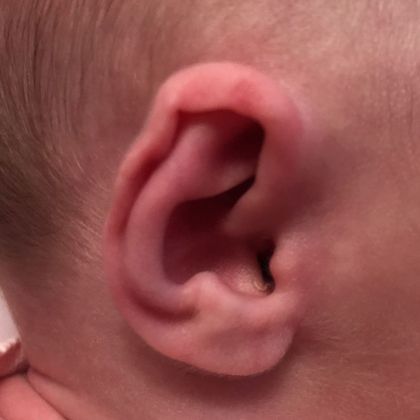 Ear Molding: Case 87 - Before