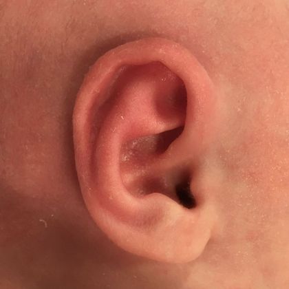 Ear Molding: Case 87 - After