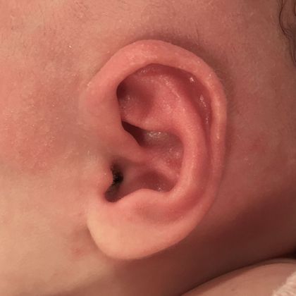 Ear Molding: Case 88 - After