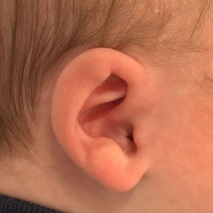 Ear Molding: Case 89 - Before