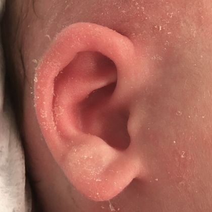 Ear Molding: Case 89 - After