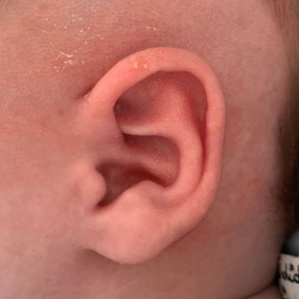 Ear Molding: Case 91 - After