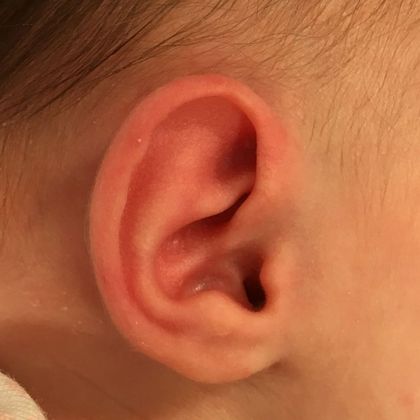Ear Molding: Case 93 - After