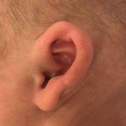 Ear Molding: Case 94 - Before