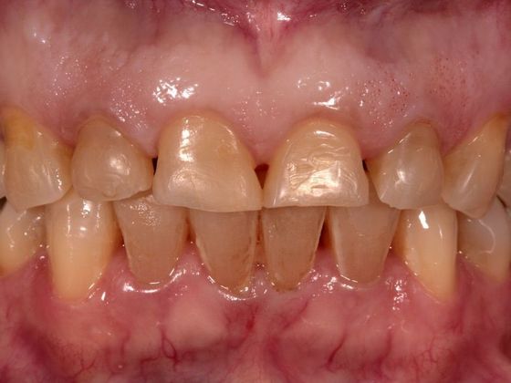 Porcelain Crowns: Case 6 - Before