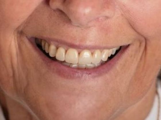 Porcelain Crowns: Case 6 - After