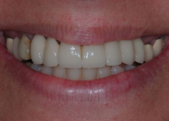 Porcelain Crowns: Case 8 - Before