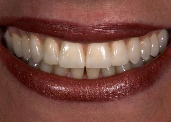 Porcelain Crowns: Case 8 - After