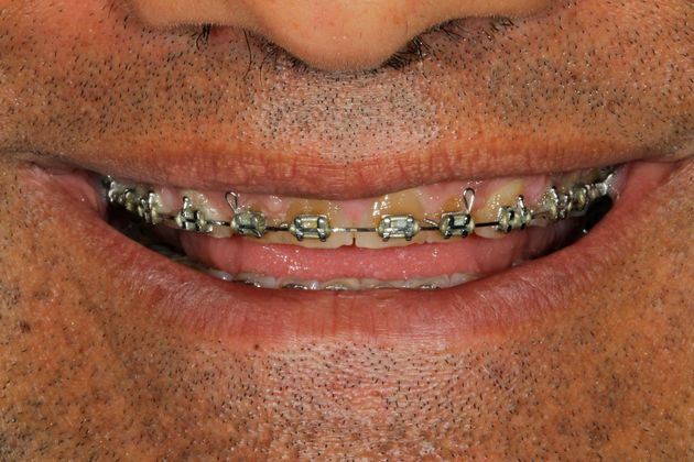 Porcelain Crowns: Case 9 - Before