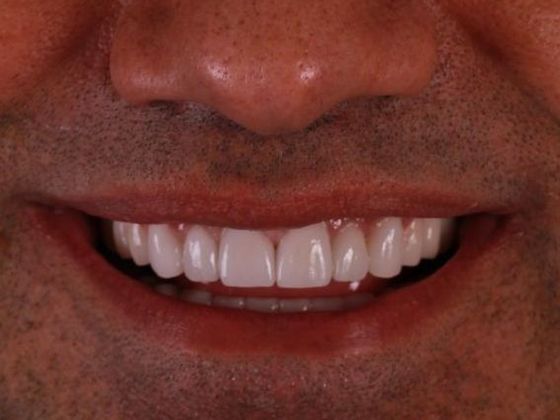 Porcelain Crowns: Case 9 - After