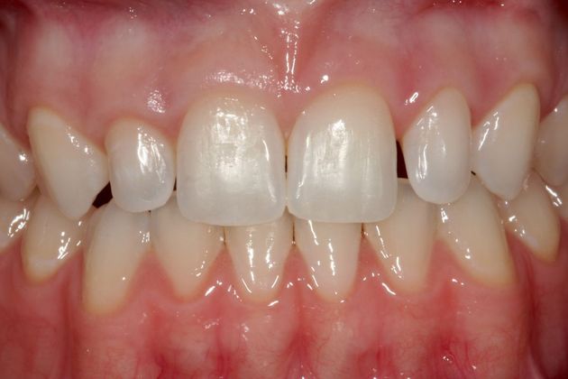 Veneers Case 1 - Before