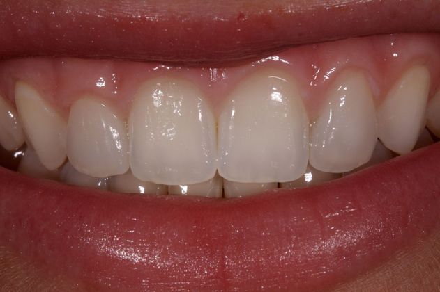 Veneers Case 1 - After