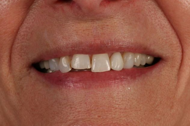 Veneers Case 2 - Before
