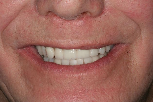 Dental Implants: Case 9 - Before