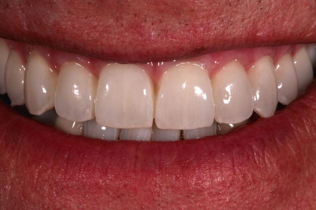 Dental Implants: Case 9 - After